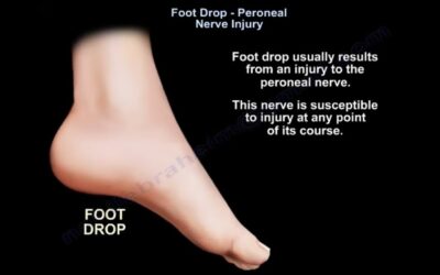 Foot Drop, peroneal nerve Injury