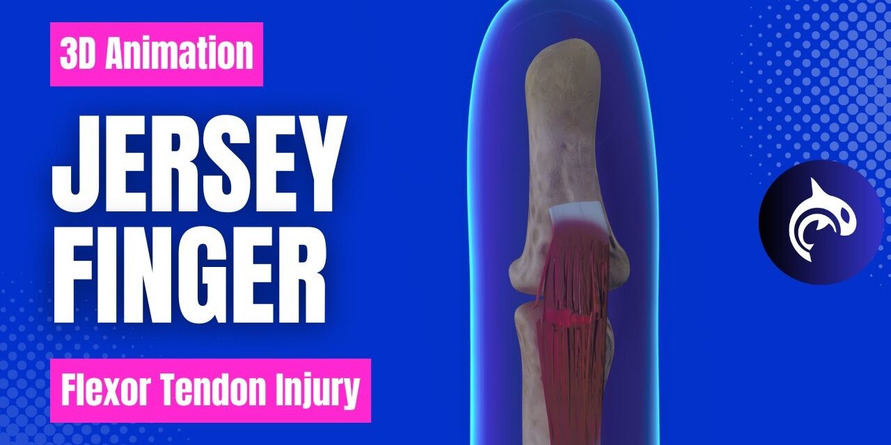 Jersey Finger (Flexor Tendon) Injury and Surgery – 3D animation