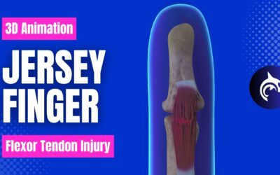 Jersey Finger (Flexor Tendon) Injury and Surgery – 3D animation