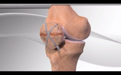 Patella Fracture Repair