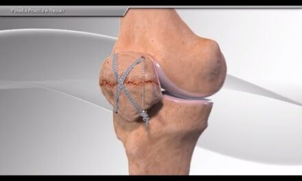 Patella Fracture Repair