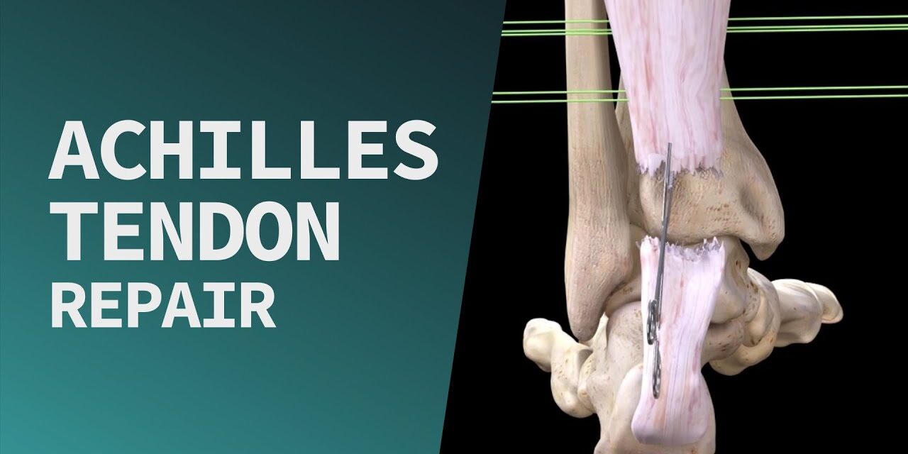 Achilles Tendon Repair