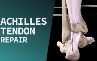 Achilles Tendon Repair