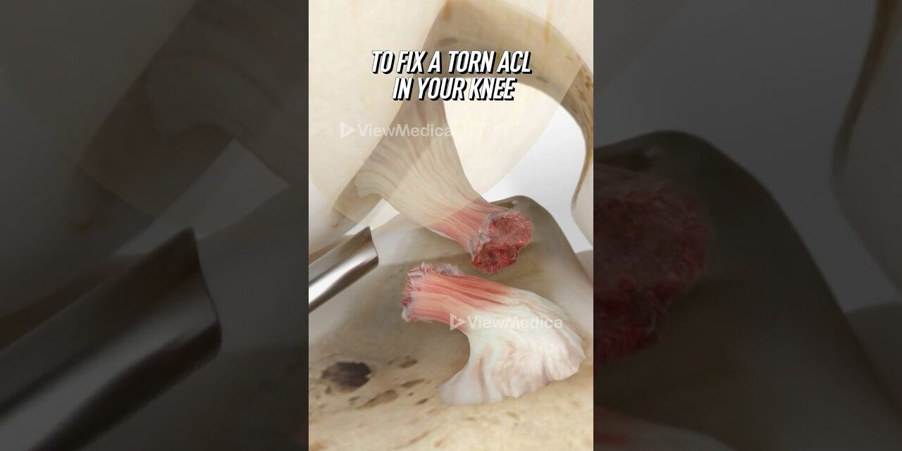 ACL reconstruction using your own tendon (3D Animation)