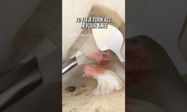 ACL reconstruction using your own tendon (3D Animation)