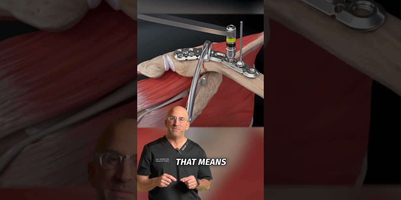 Collare Bone Plate and Screws #shorts