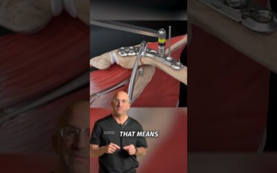 Collare Bone Plate and Screws #shorts