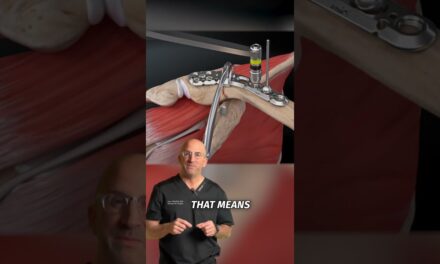 Collare Bone Plate and Screws #shorts