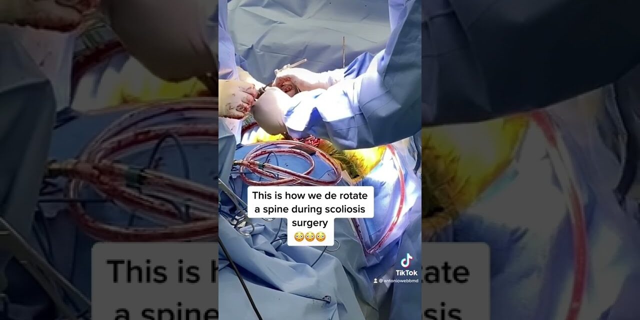 DeRotating a 75 degree Scoliosis Curve!