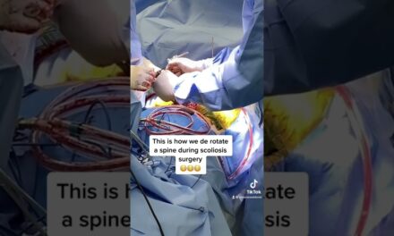 DeRotating a 75 degree Scoliosis Curve!