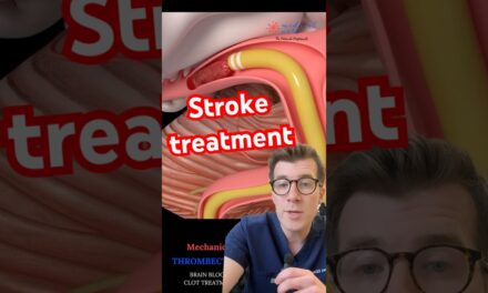 Doctor explains STROKE TREATMENT – clot removal #shorts