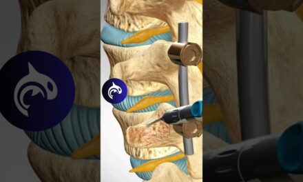 See how a Lumbar Fusion of the Spine works in 3D animation #backpain #stem #spine